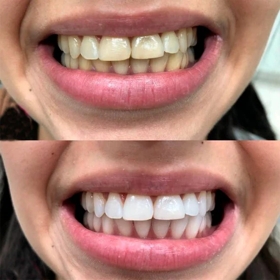 crema dental morada blanqueadora